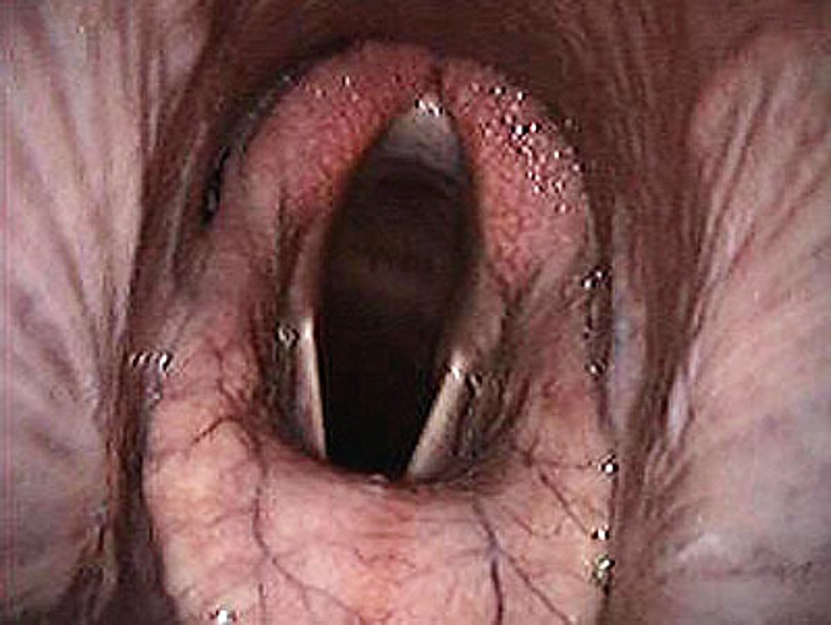 Image endoscopique en gros plan d'un larynx montrant les cordes vocales entrouvertes et les tissus rosés environnants.